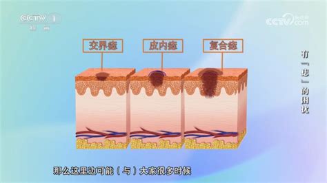 痣變大變凸|痣增大且凸起，是否需要手術切除？